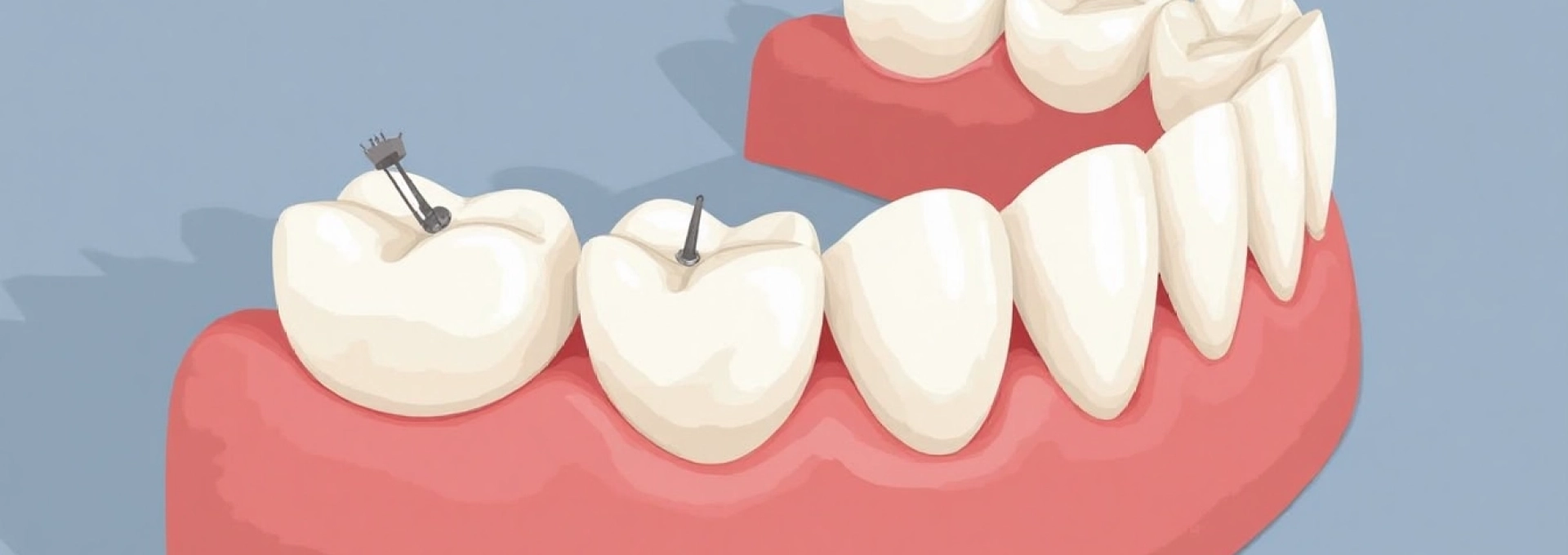 etapes-de-la-pose-de-facettes-dentaires-du-diagnostic-au-resultat